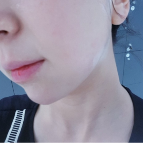#잠실점#슈링크300샷#리프팅후기